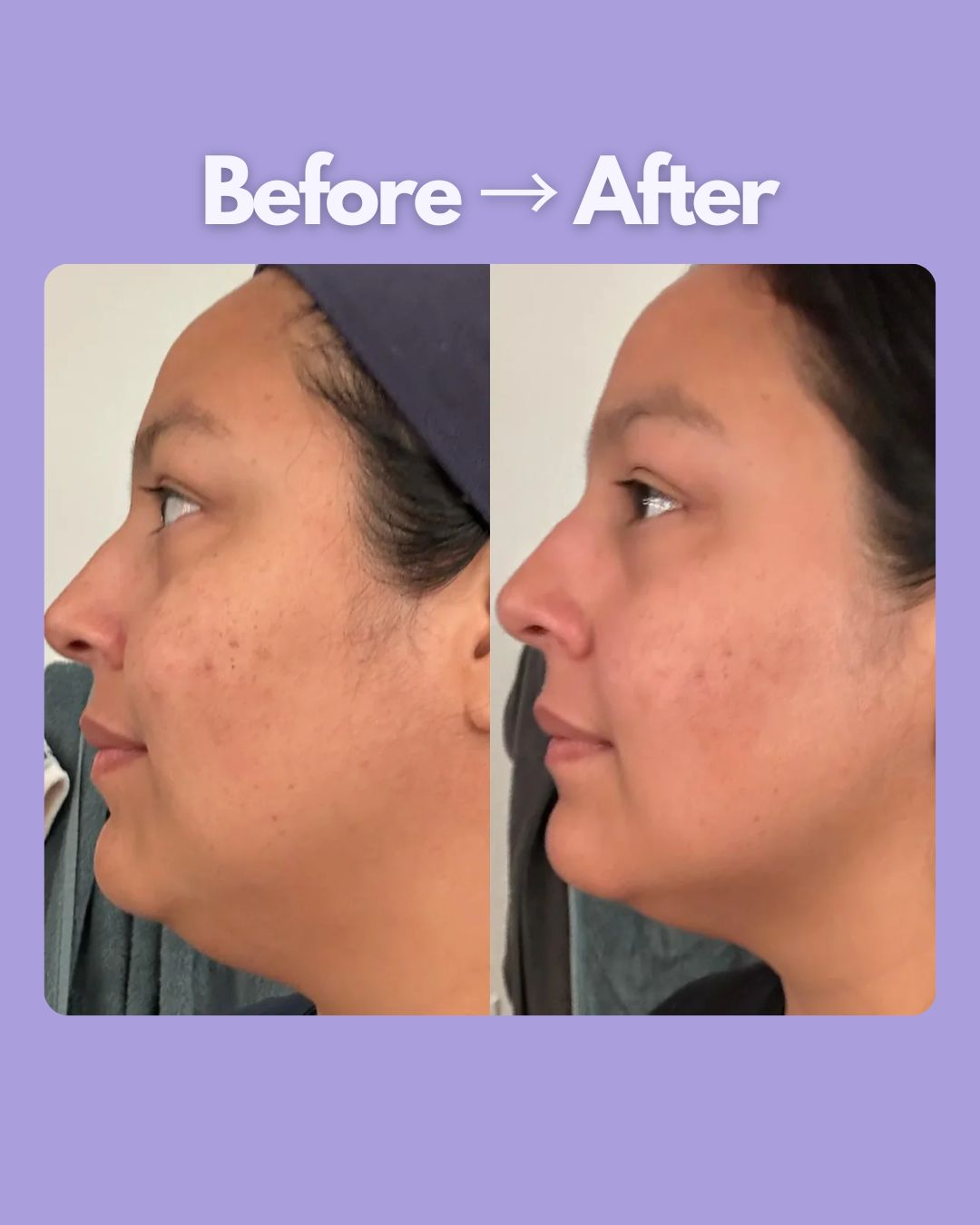 Evaura™ 7-in-1 LED Facial Sculptor