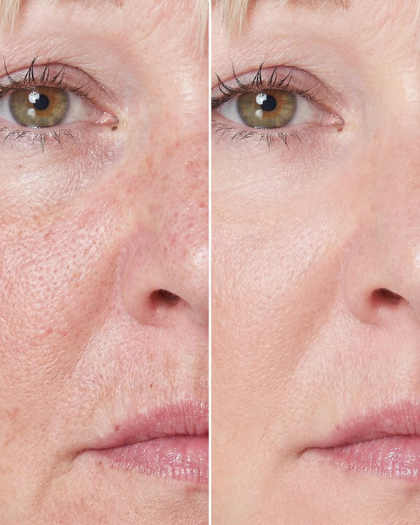 LumiAura® Pro LED Skin Renewal Mask