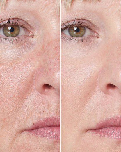 LumiAura® Pro LED Skin Renewal Mask